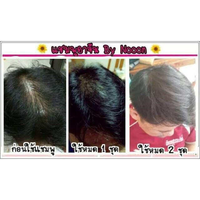 Noon Chinese Herbal Long Hair Shampoo Conditioner Serum Straightening ( 2Set)